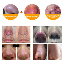 Load image into Gallery viewer, K - Rosacea Formula Best Rosacea Treatment
